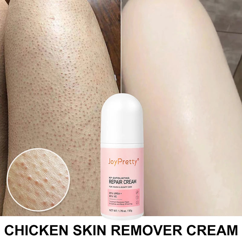 60g Body Cream Chicken Skin Removal Treatment Keratosis Pilaris Lotion Rough Bumpy Pore Spots Care Moisturizer Whitening Creams